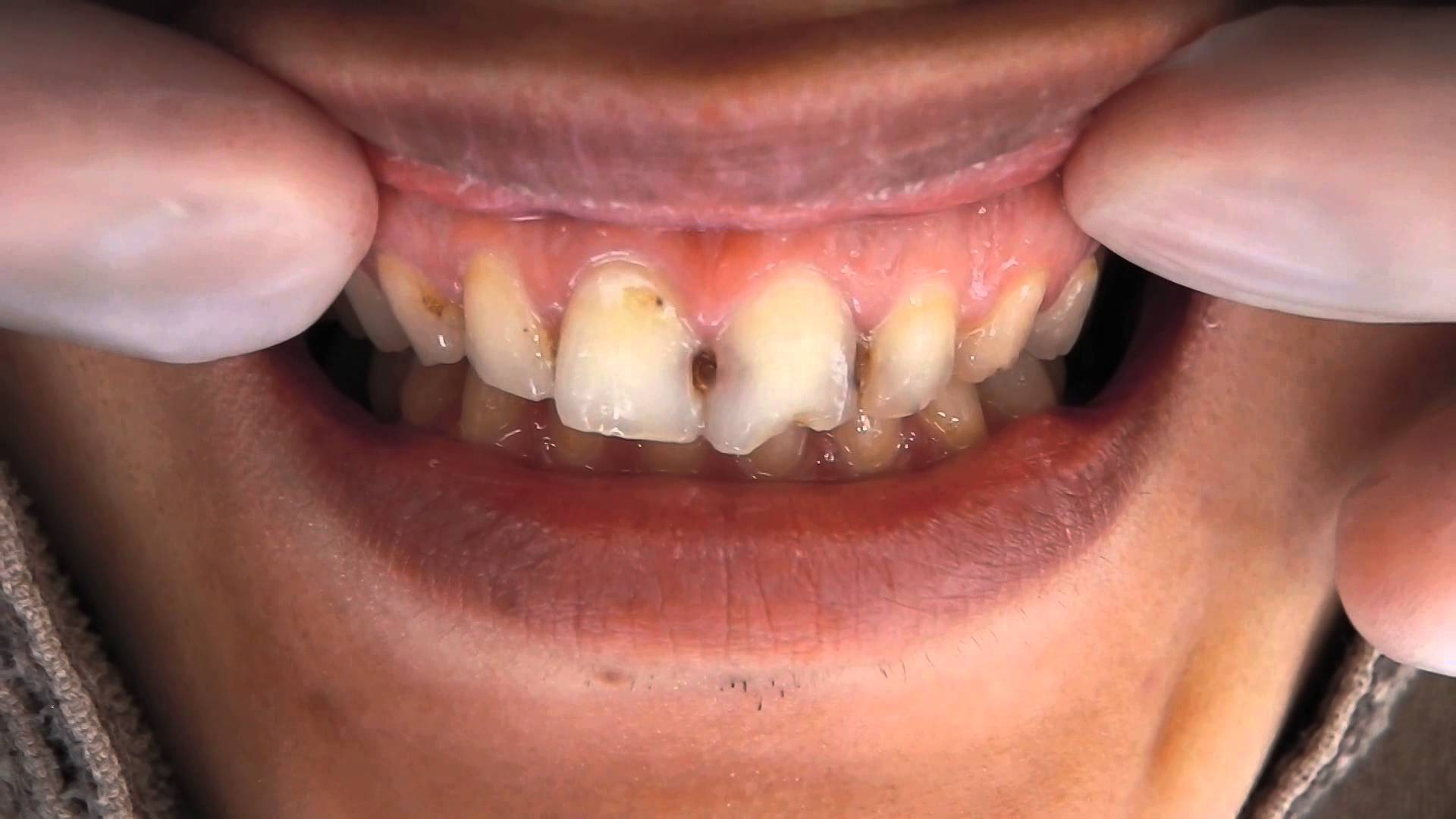 前歯の歯並び症例374 前歯の虫歯 全歯ダイヤモンド今井院長 歯並び矯正ホワイトニング大阪無痛治療歯科